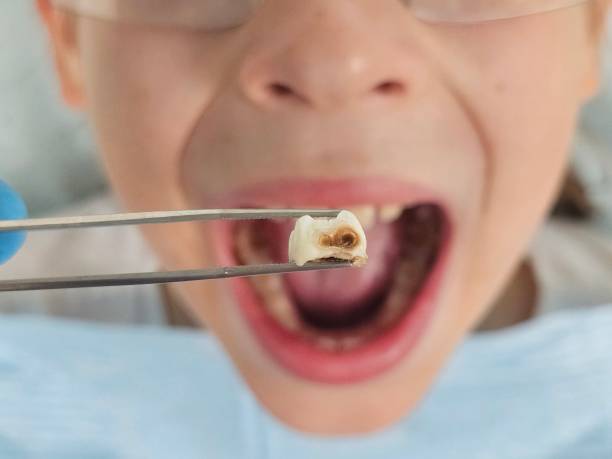 Best Emergency Wisdom Teeth Removal in Lanster, CA